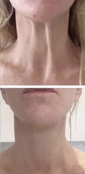 Before and after nefertiti lift at our Sydney clinic to prevent and treat neck ageing